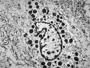 F,72y. | melanoblastoma oculi